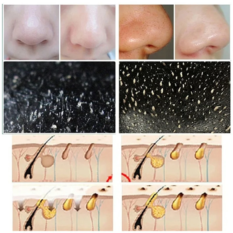 10개 블랙헤드 코팩 딥 클렌징 코 모공 스티커 여드름 - Cleanser Face 리뷰 및 가격