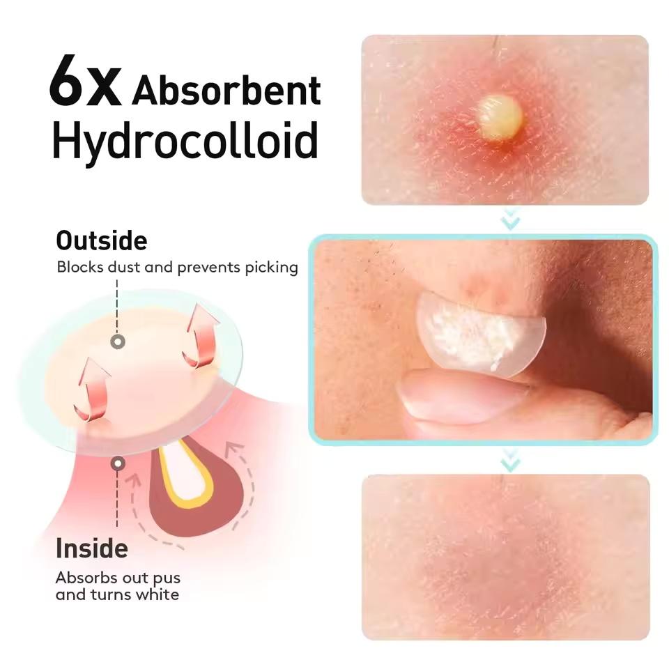 투명 하이드로겔 여드름 패치 720/360/180개/박 - Face Oil 리뷰 및 가격